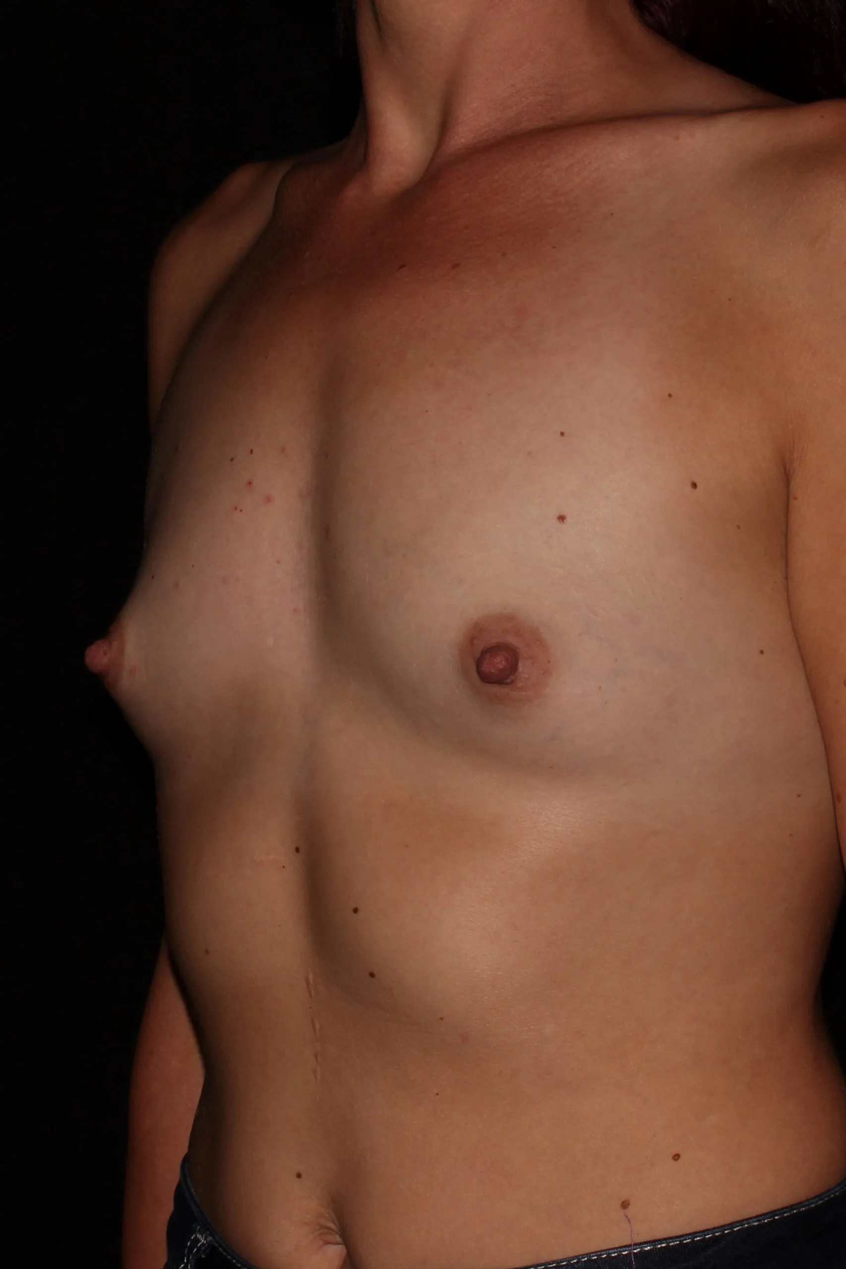 Case #4493 before oblique