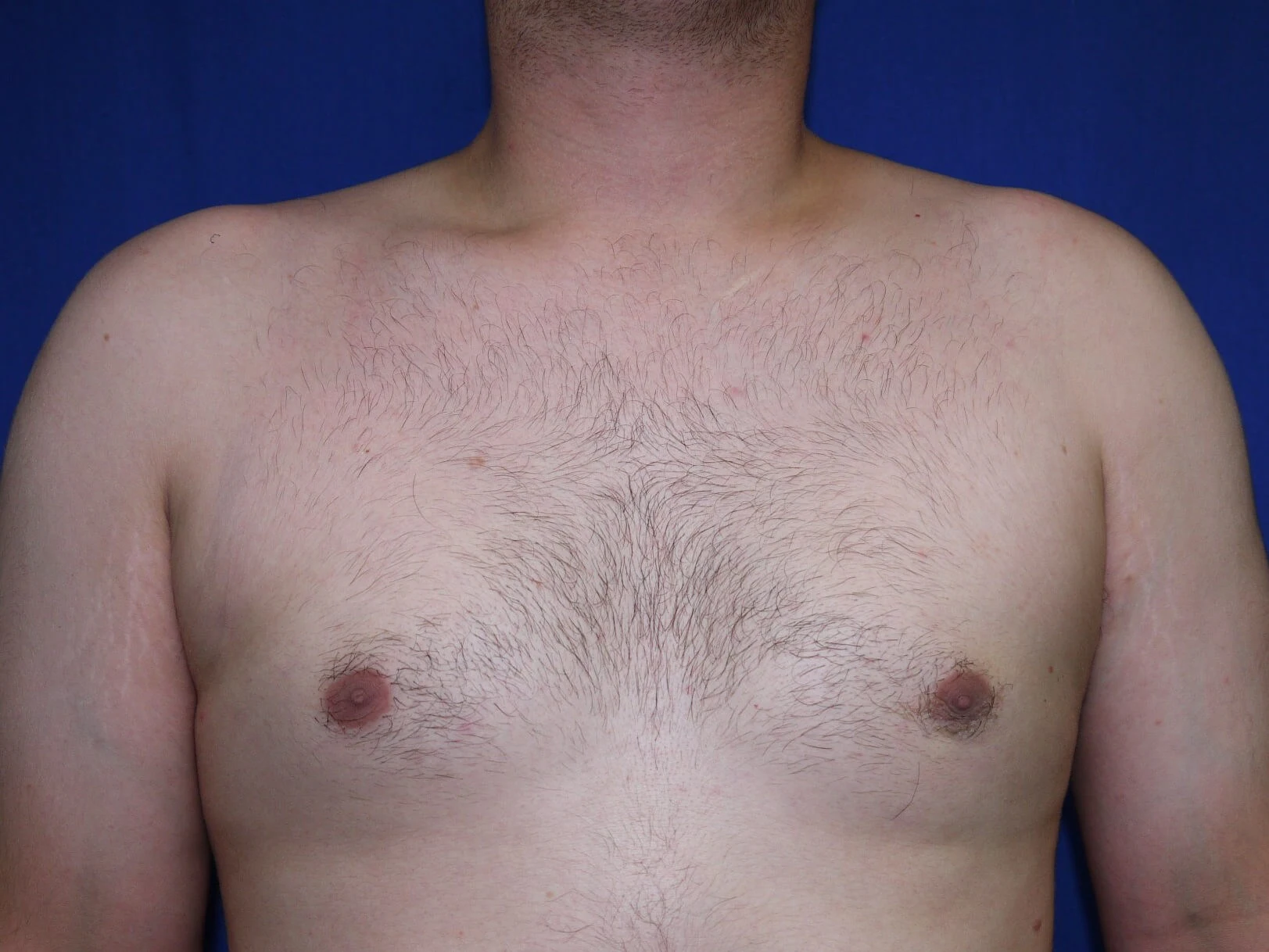Case #36422 after front