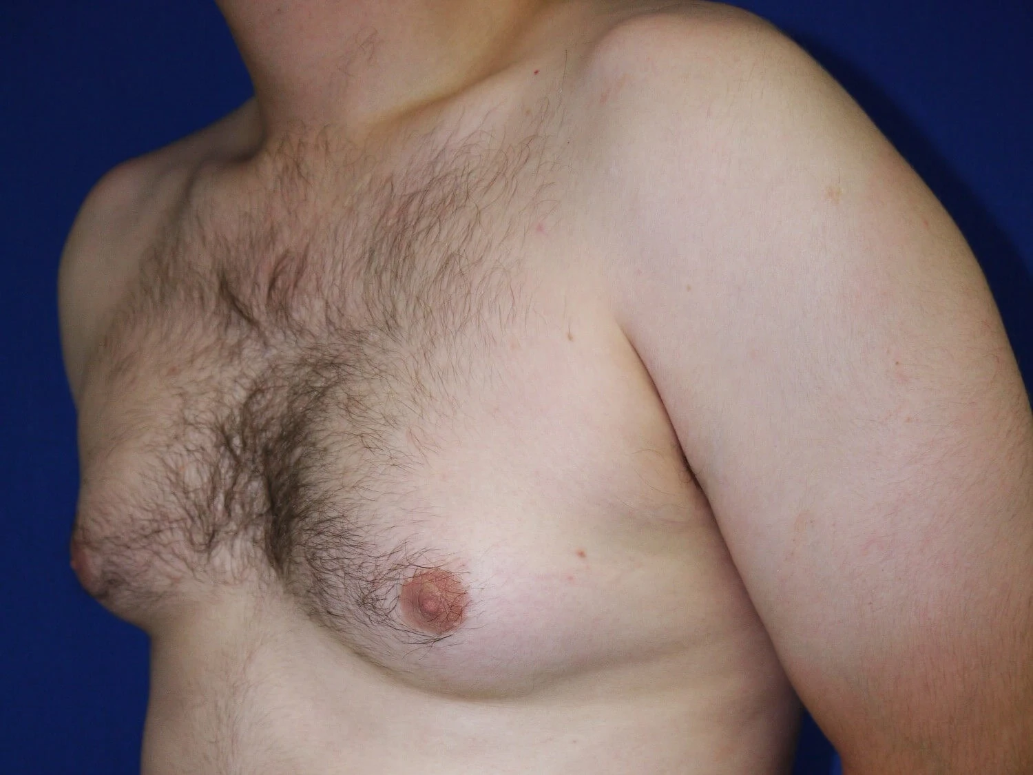 Case #36422 before left oblique