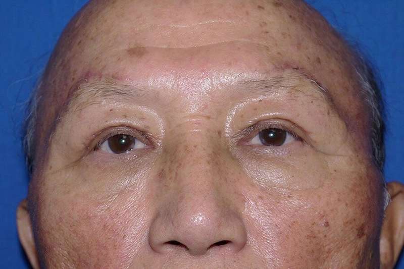 Case #17667 after_opt