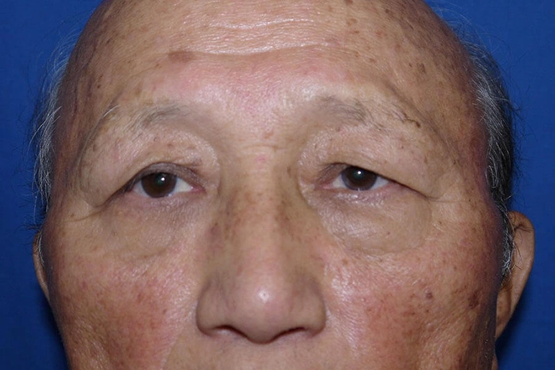 Case #17667 before_opt