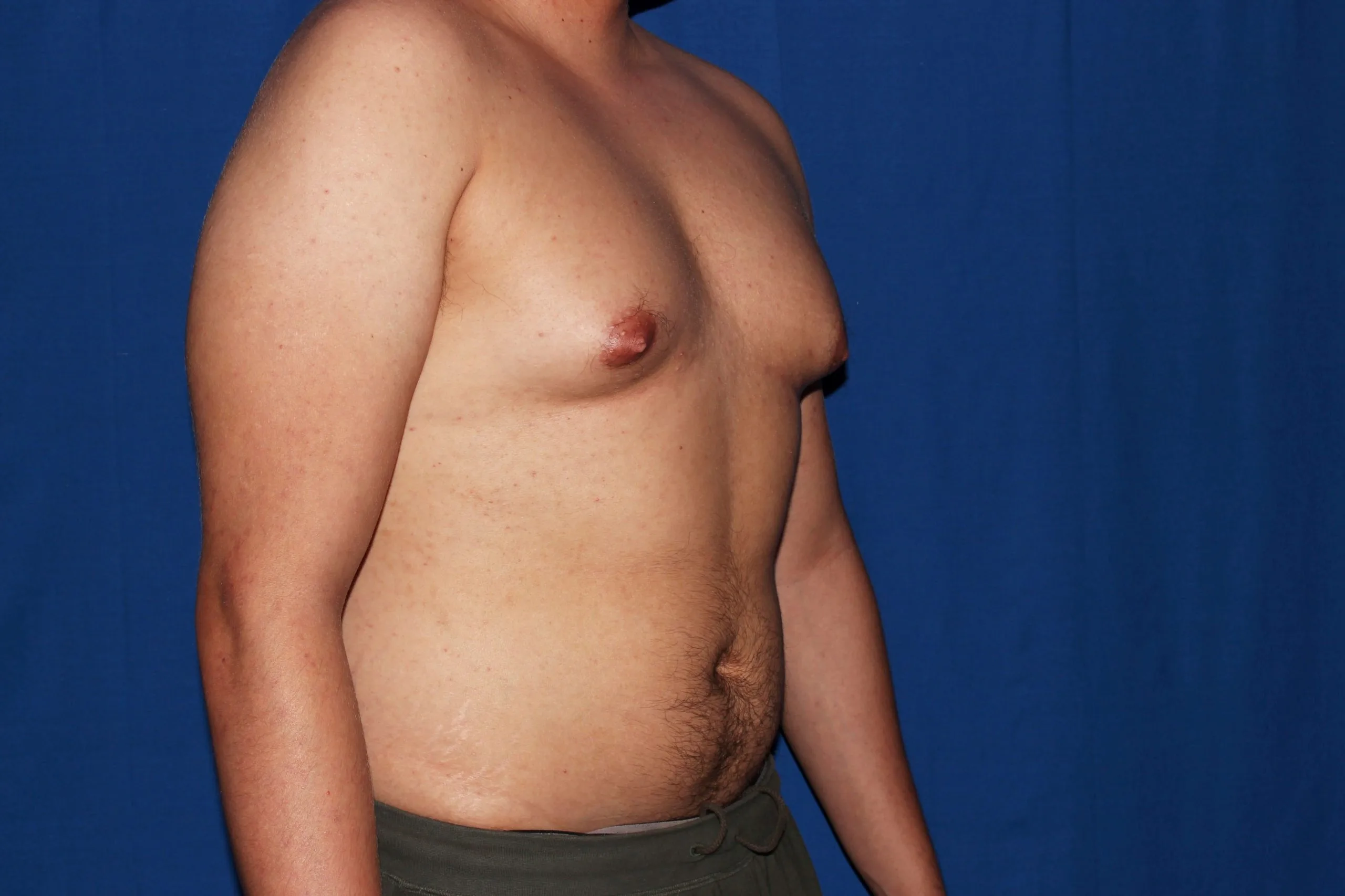 Case #33720 before right oblique