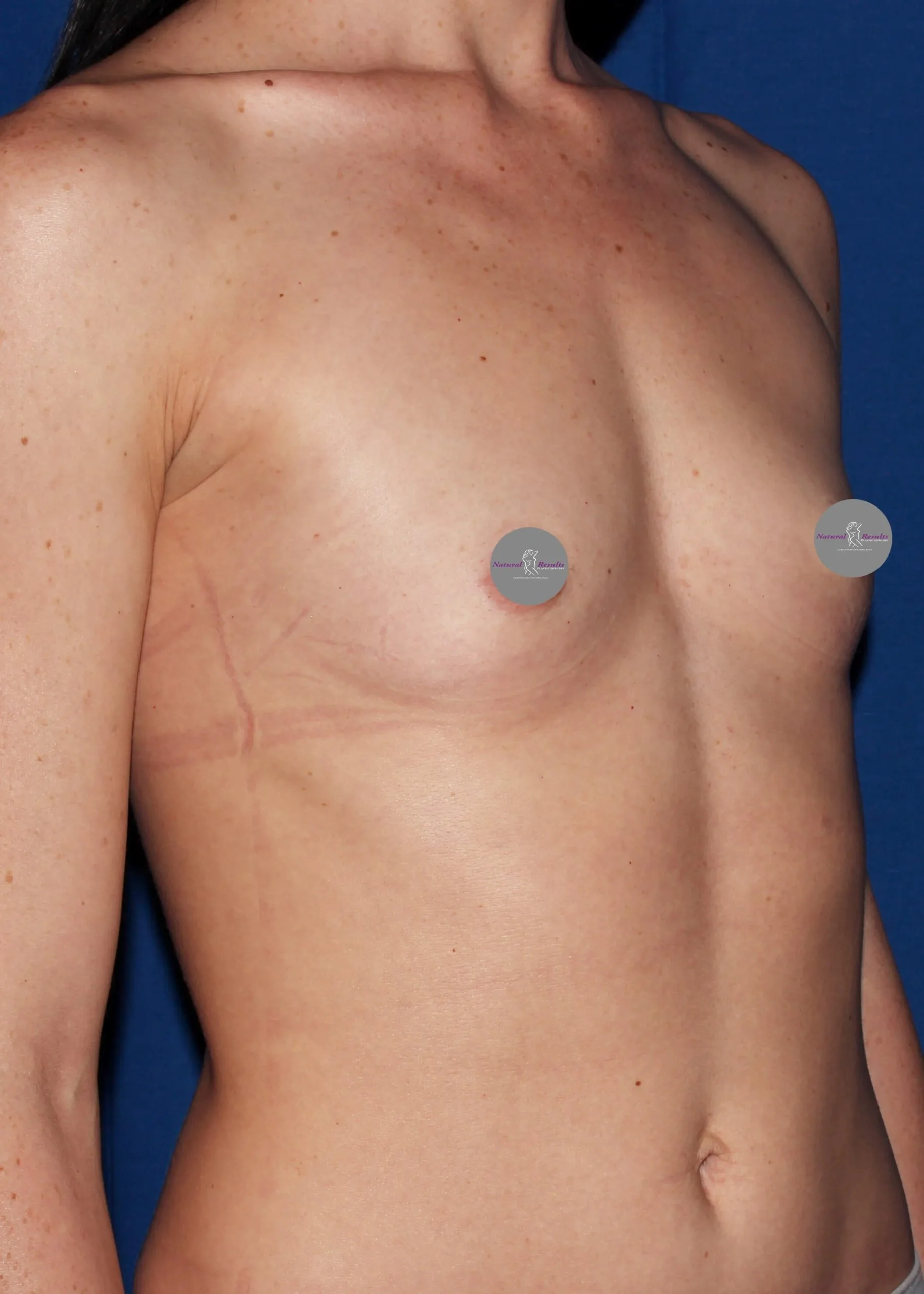 Case #31575 before oblique