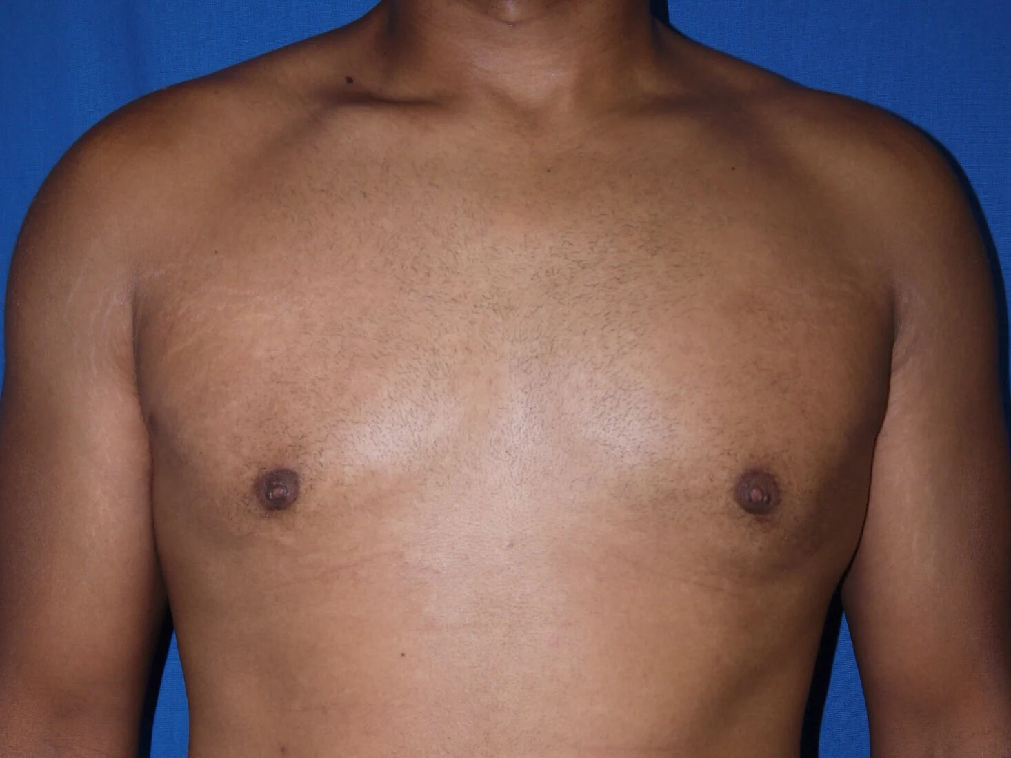 Case #36390 After front