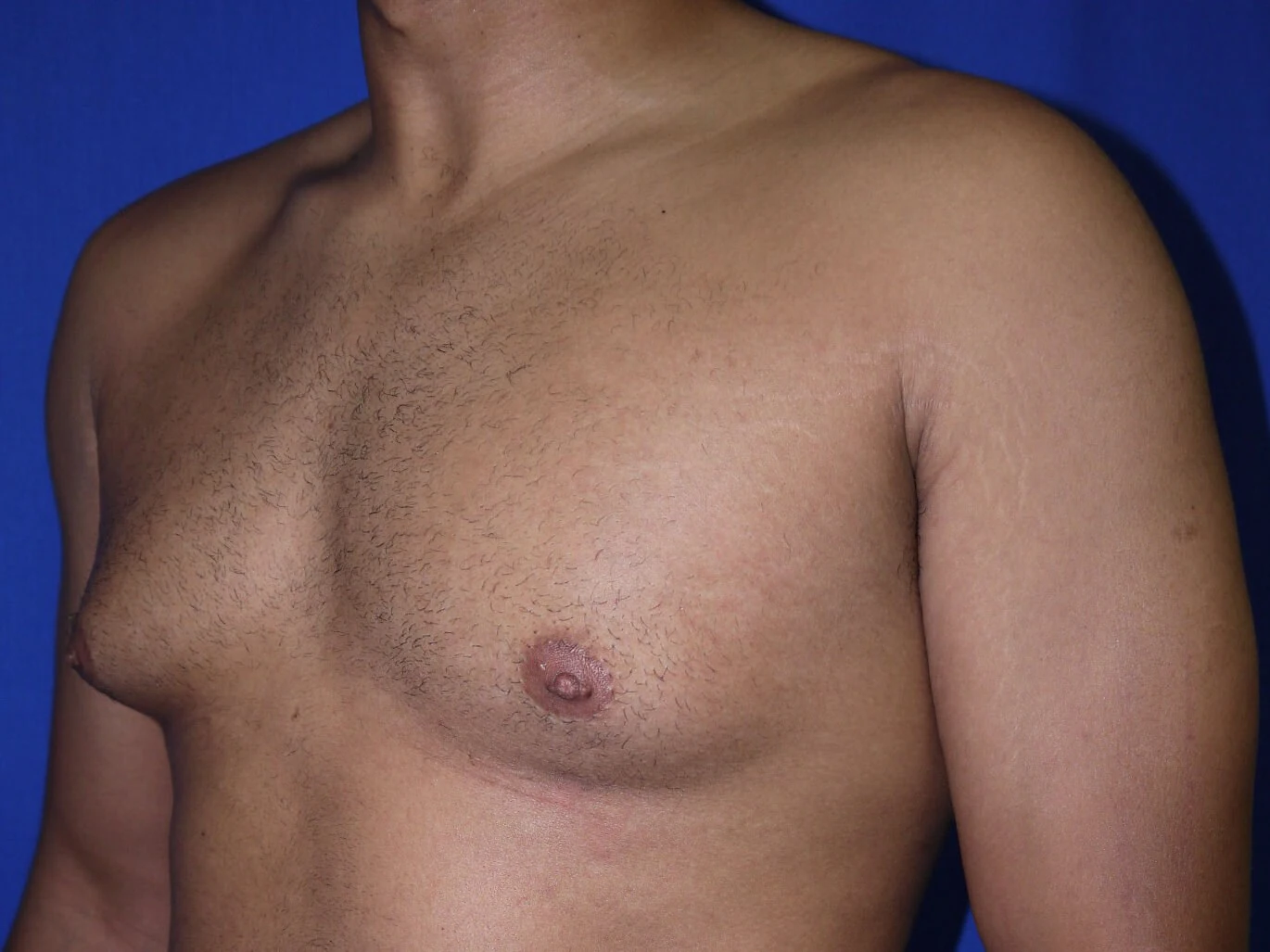 Case #36390 before left oblique