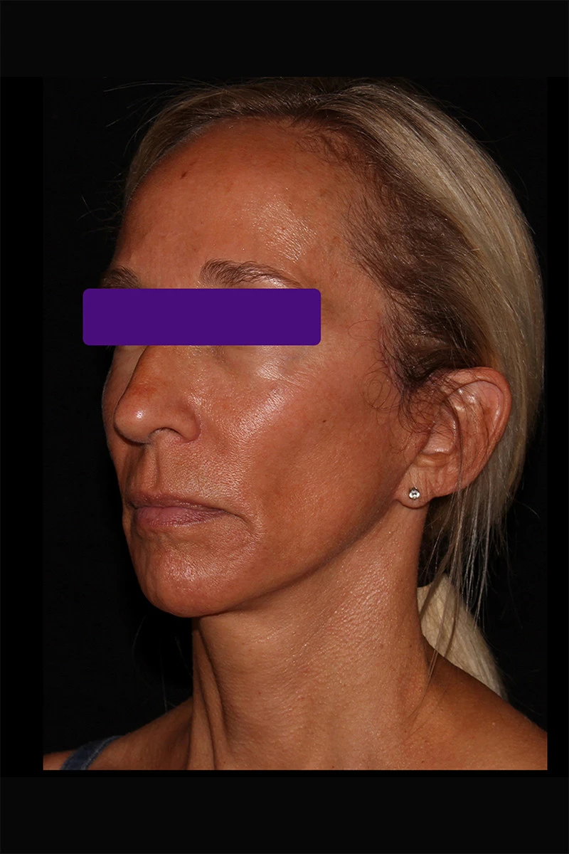 Case #5582 after_oblique_opt